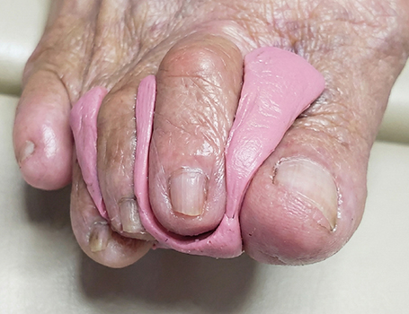 Ortoplastia